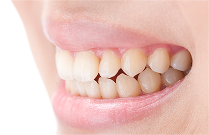 歯ぎしり・食いしばり