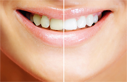 ホワイトニング