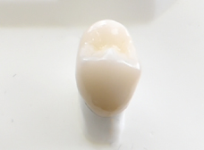 オールセラミック